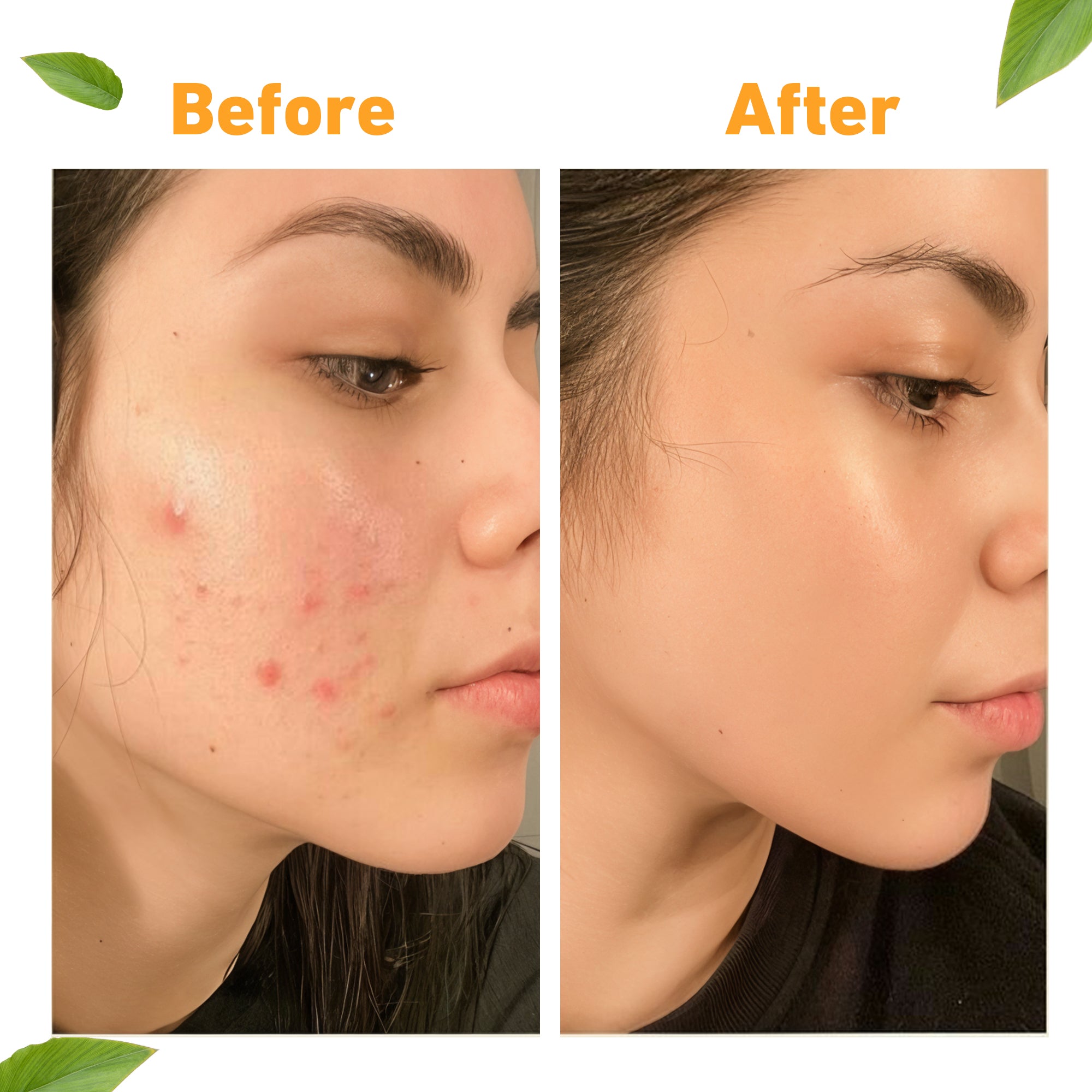 KYING® Blemfix Everyday Crème Serum, 30g - Fix Pigmentation, Acne Marks & Dark Spots